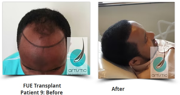 Patient before and after hair transplant results from Artistic Clinic Nairobi